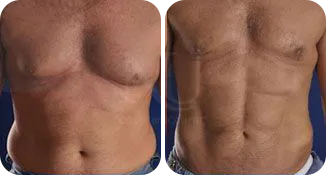 vaser lipo male before and after result